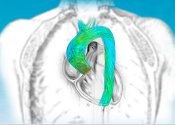 Digital twin of the aortic arch defined to support medical doctors in aneurysms prevention and correction